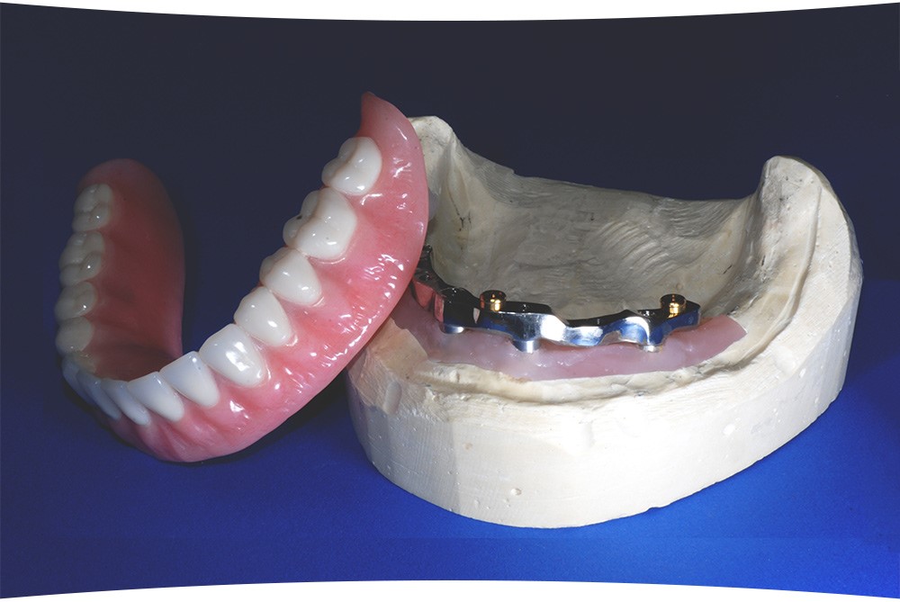 Lower Dentures Won'T Stay In Clearlake CA 95422